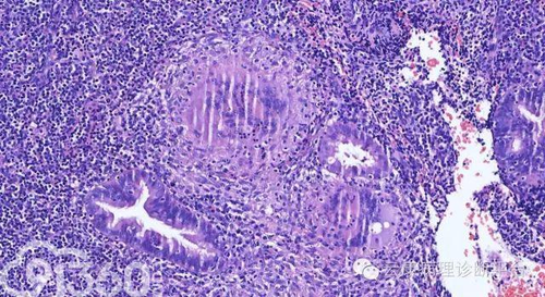 子宫内膜结核会复发吗? 子宫内膜结核会复发吗?