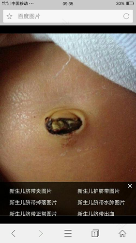 女性肚脐眼出水是怎么回事 女性肚脐眼出水是怎么回事