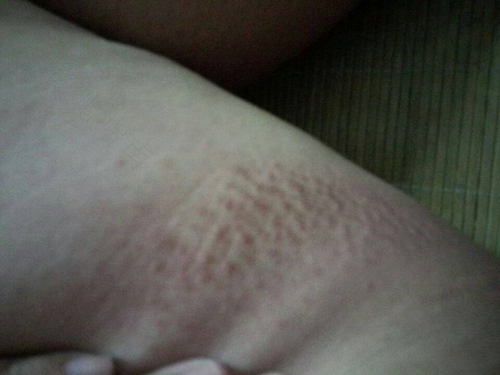 大腿两侧有点黑是什么原因 大腿两侧有点黑是什么原因