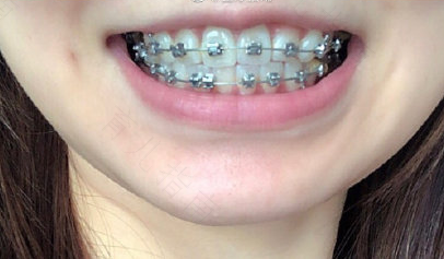 20岁牙齿矫正大概要花费多少钱 20岁牙齿矫正大概要花费多少钱