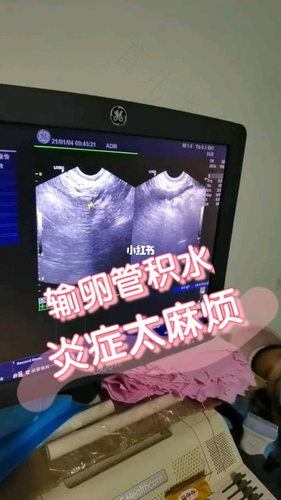 输卵管炎症能自愈吗 输卵管炎症能自愈吗