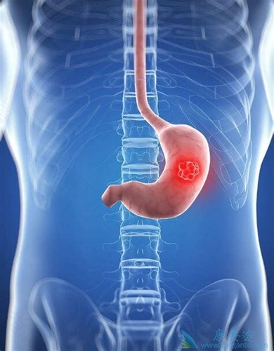 腹腔肿瘤腹水怎么办 腹腔肿瘤腹水怎么办