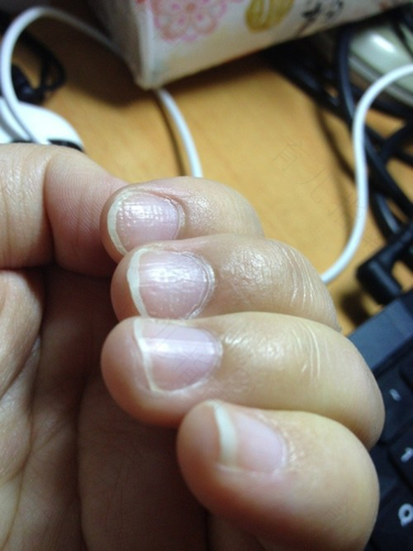 手指甲总是长不长怎么办