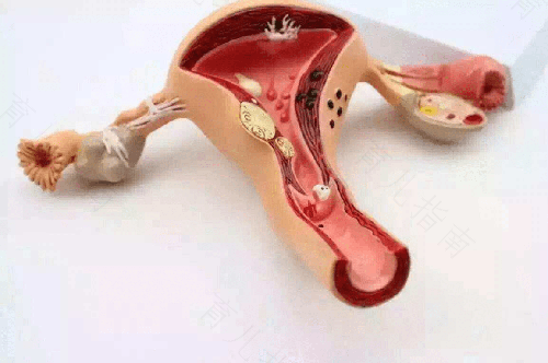 什么是子宫腺肌症伴腺肌瘤 什么是子宫腺肌症伴腺肌瘤