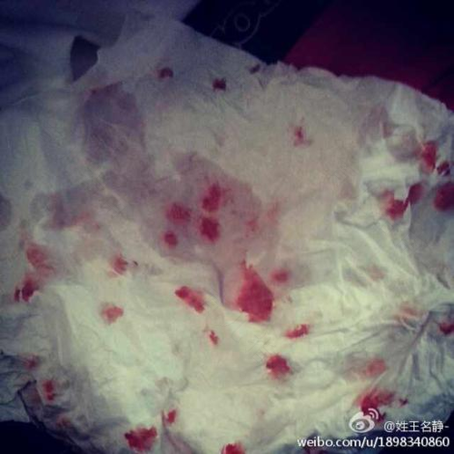 吸痰吸出血是怎么回事 吸痰吸出血是怎么回事