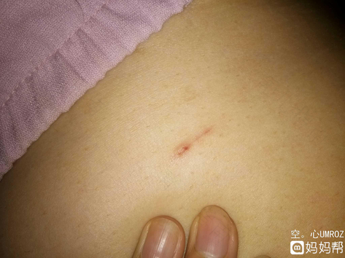 小伤口感染红肿怎么办