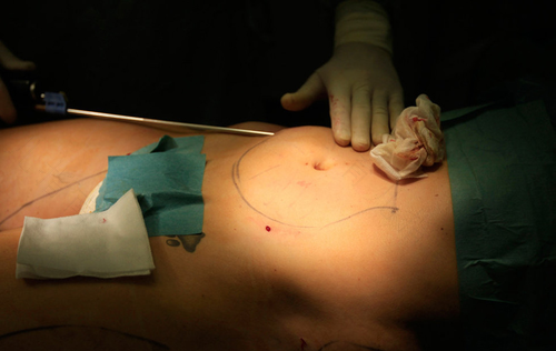 副乳需要手术切除吗 副乳需要手术切除吗