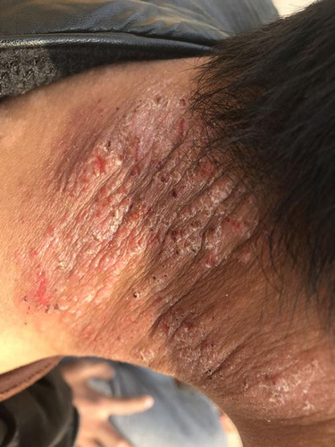 睡觉时痒是什么原因