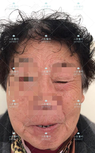 面部肌肉抽搐什么原因 面部肌肉抽搐什么原因