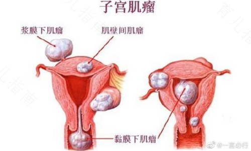 子宫息肉会自己消失吗
