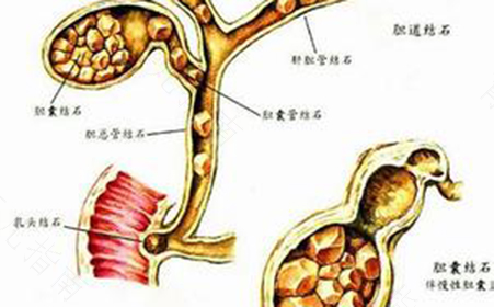 轻度肾结石有什么症状 轻度肾结石有什么症状