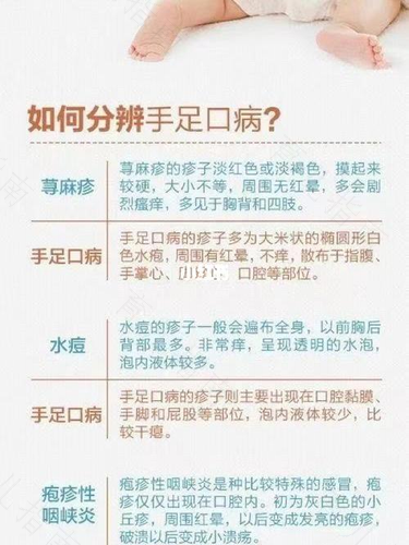 手足口病爱睡觉正常吗 手足口病爱睡觉正常吗