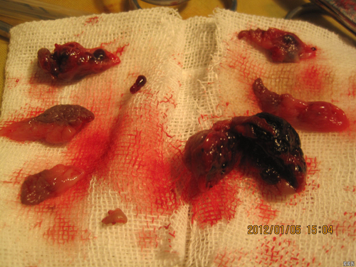 痔疮手术后怎么消除水肿 痔疮手术后怎么消除水肿