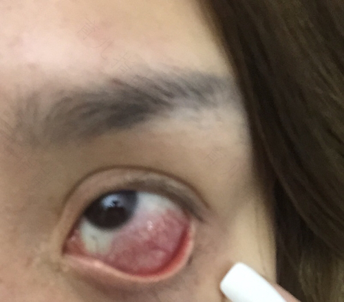 眼睛里面化脓了怎么办 眼睛里面化脓了怎么办