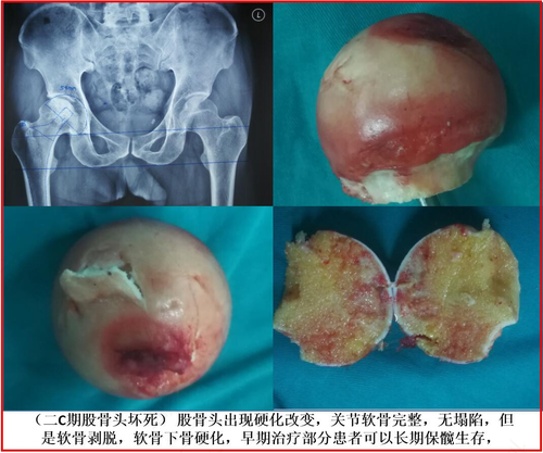股骨头坏死做什么检查确诊 股骨头坏死做什么检查确诊