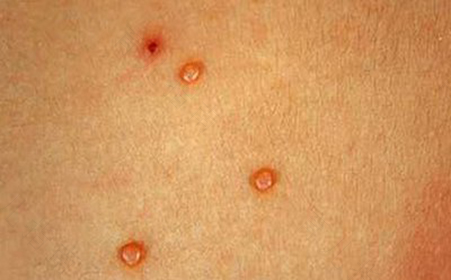 扁平疣的症状表现有哪些 扁平疣的症状表现有哪些