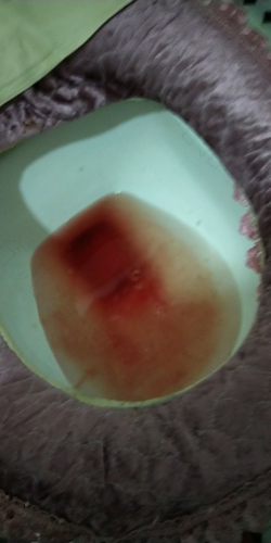 小便有淤血是怎么回事 小便有淤血是怎么回事