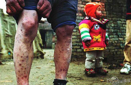 感染艾滋病多久能发现症状 感染艾滋病多久能发现症状