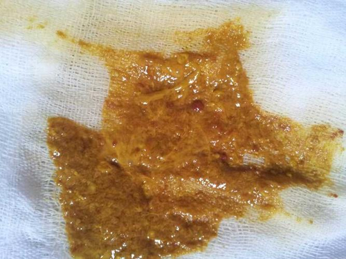 大便褐色正常吗? 大便褐色正常吗?