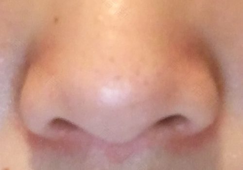 鼻孔干燥一直有血怎么回事 鼻孔干燥一直有血怎么回事