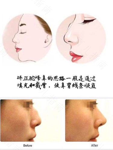 鼻软骨没发育好的症状 鼻软骨没发育好的症状