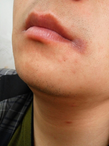 嘴角两侧发红怎么回事 嘴角两侧发红怎么回事