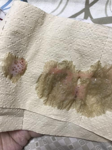 早晚咳嗽有浓痰是怎么回事