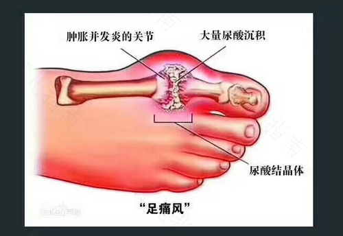 有痛风如何治疗 有痛风如何治疗