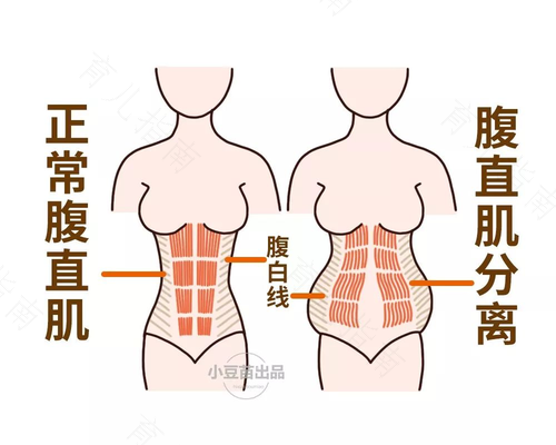 产后腹部松弛下垂怎么办