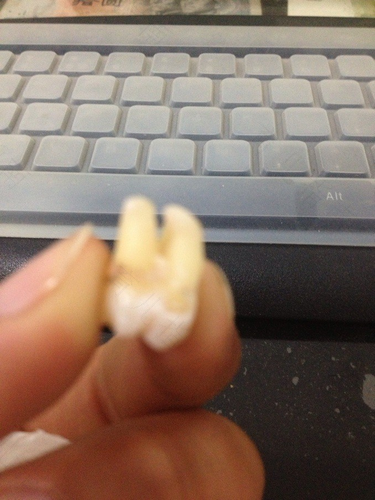 一般拔牙后多久不疼了