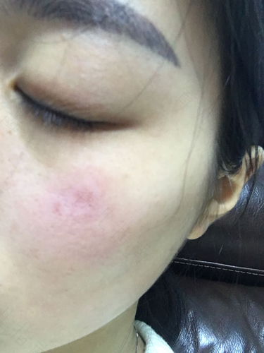 长年过敏怎么办 长年过敏怎么办