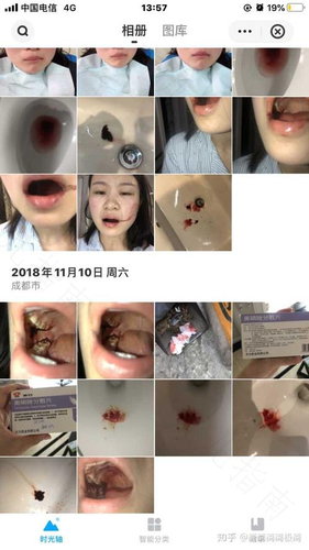拔智齿之后流血怎么办