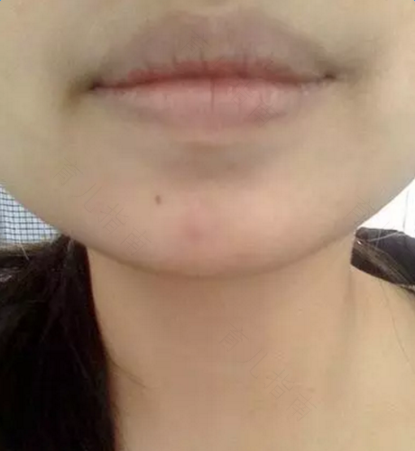 小孩发烧嘴唇发黑怎么回事