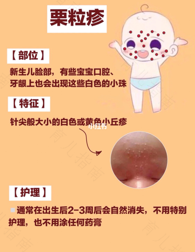 湿疹和痱子有什么区别 湿疹和痱子有什么区别