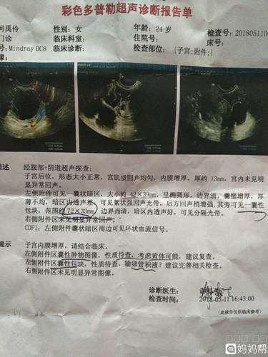 宫腔多发性囊肿是什么意思 宫腔多发性囊肿是什么意思