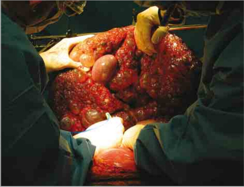 多囊肾还能活多久 多囊肾还能活多久