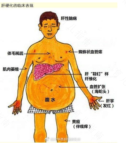 宝宝肚子里面有腹水怎么办 宝宝肚子里面有腹水怎么办