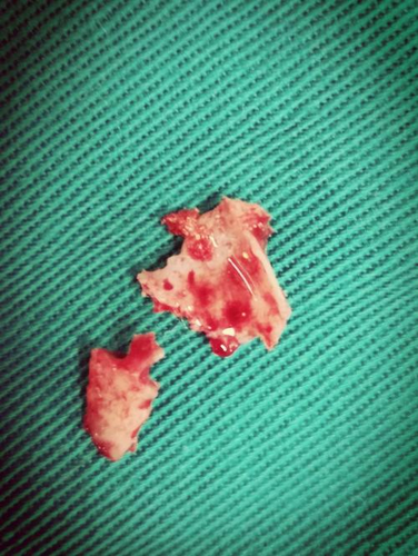 拔牙之后渗血怎么办 拔牙之后渗血怎么办