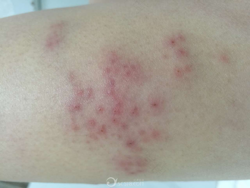 病毒性疱疹发烧怎么办大人