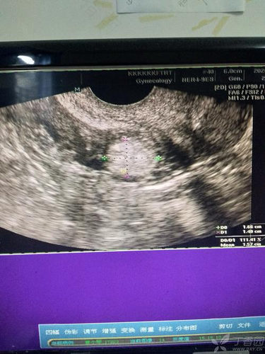 宫颈处强回声考虑积血 宫颈处强回声考虑积血