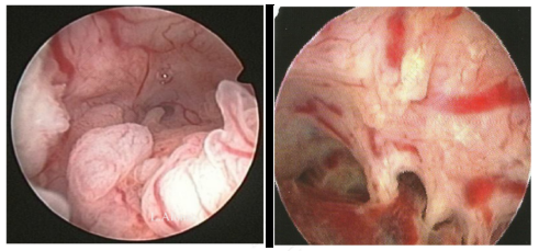 子宫癌怎么治疗彻底 子宫癌怎么治疗彻底