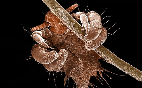 阴虱治疗一般需要几天 阴虱治疗一般需要几天