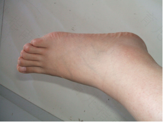 脚踝扭伤肿了怎么办几天好得快 脚踝扭伤肿了怎么办几天好得快