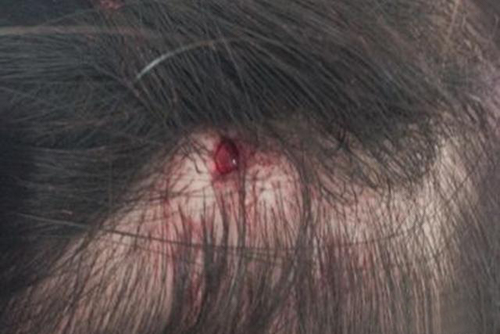 脑门磕青了怎么处理 脑门磕青了怎么处理