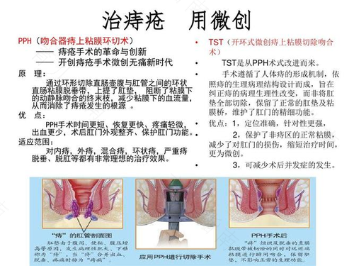 怎么治痔疮最有效果