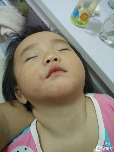 小娃儿长湿疹怎么办