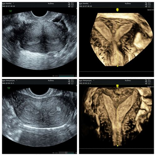 完全性纵隔子宫是什么意思 完全性纵隔子宫是什么意思