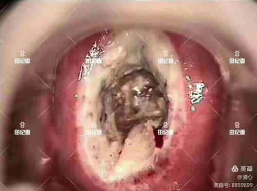 宫颈糜烂三度有血丝严重吗 宫颈糜烂三度有血丝严重吗