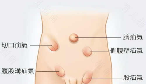 疝气是重大疾病吗 疝气是重大疾病吗