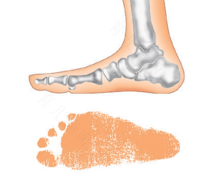 儿童扁平足能治好吗 儿童扁平足能治好吗
